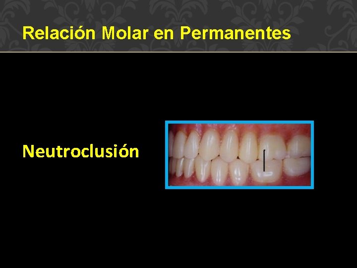 Relación Molar en Permanentes Neutroclusión 