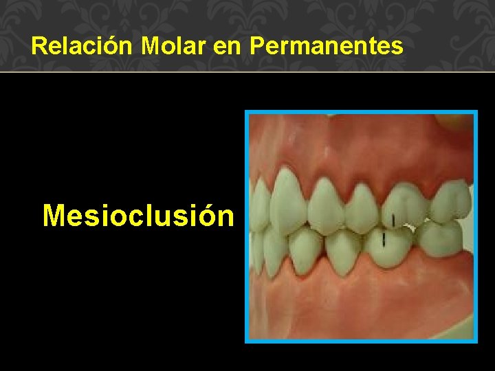 Relación Molar en Permanentes Mesioclusión 