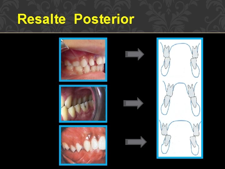 Resalte Posterior 
