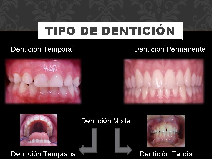 TIPO DE DENTICIÓN Dentición Temporal Dentición Permanente Dentición Mixta Dentición Temprana Dentición Tardía 