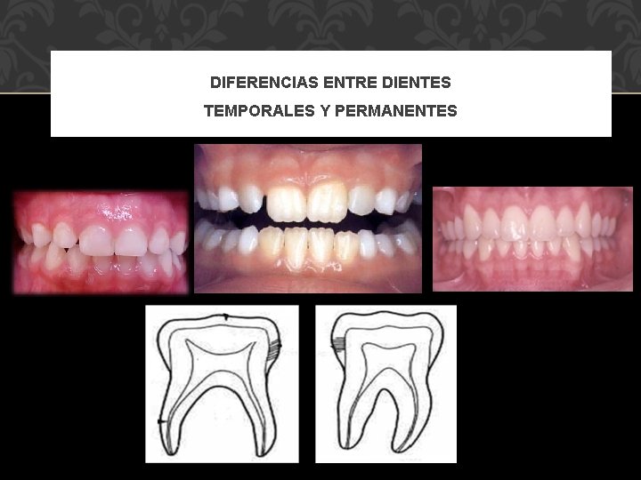 DIFERENCIAS ENTRE DIENTES TEMPORALES Y PERMANENTES 