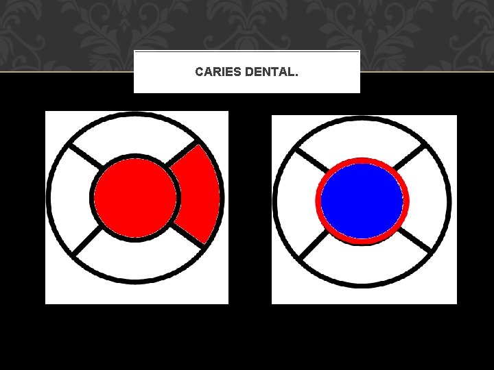 CARIES DENTAL. 