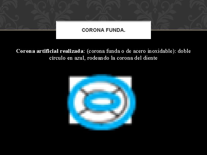 . CORONA FUNDA. Corona artificial realizada: (corona funda o de acero inoxidable): doble círculo