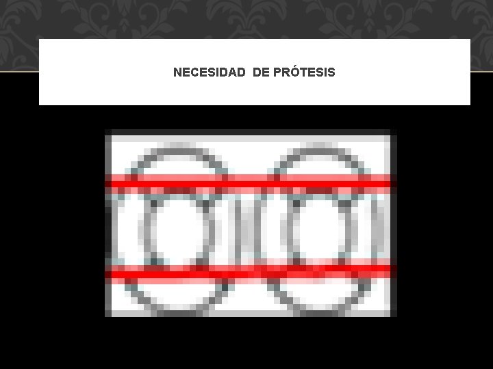 NECESIDAD DE PRÓTESIS 