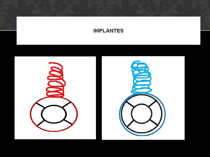 IMPLANTES 