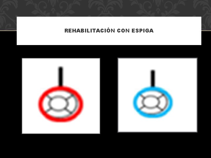 REHABILITACIÓN CON ESPIGA 