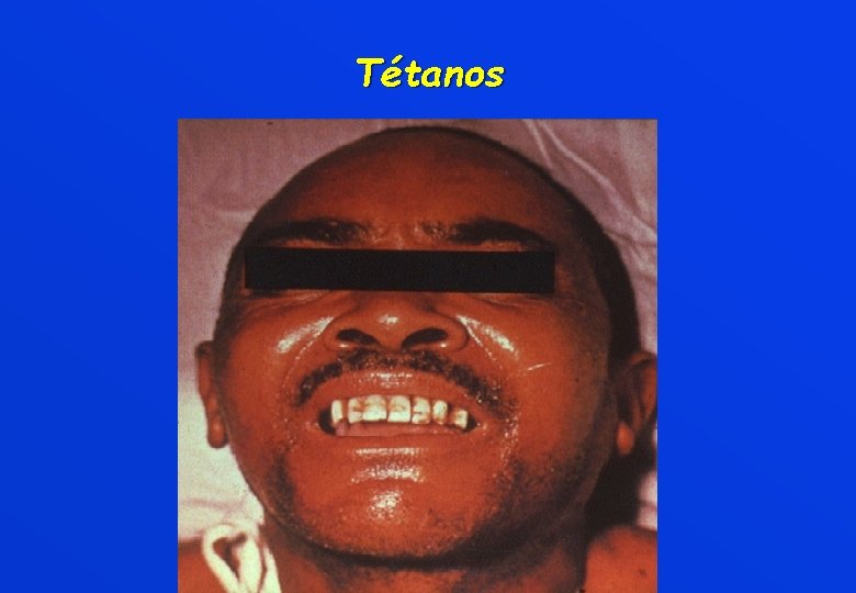 Tétanos 