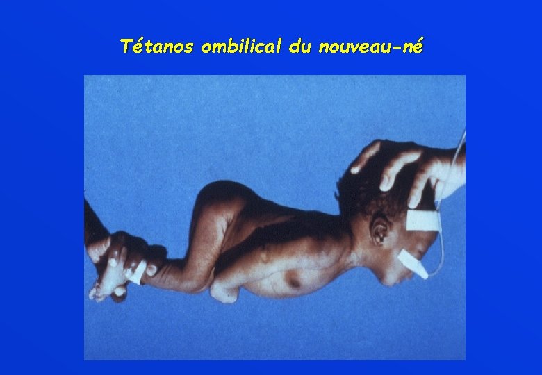 Tétanos ombilical du nouveau-né 