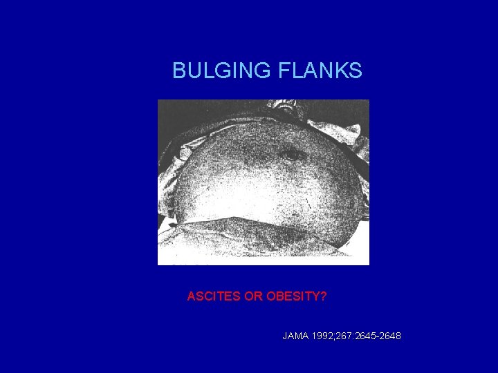 BULGING FLANKS ASCITES OR OBESITY? JAMA 1992; 267: 2645 -2648 
