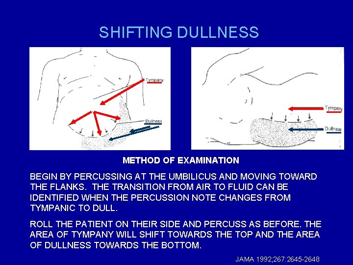 SHIFTING DULLNESS METHOD OF EXAMINATION BEGIN BY PERCUSSING AT THE UMBILICUS AND MOVING TOWARD