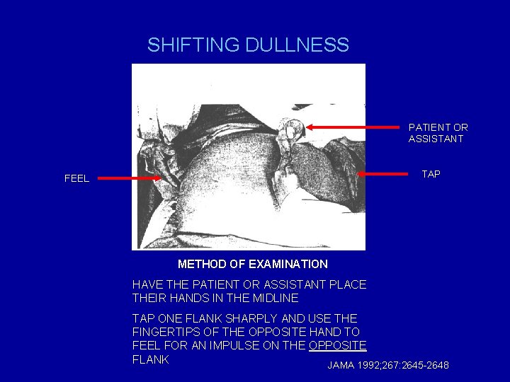 SHIFTING DULLNESS PATIENT OR ASSISTANT TAP FEEL METHOD OF EXAMINATION HAVE THE PATIENT OR