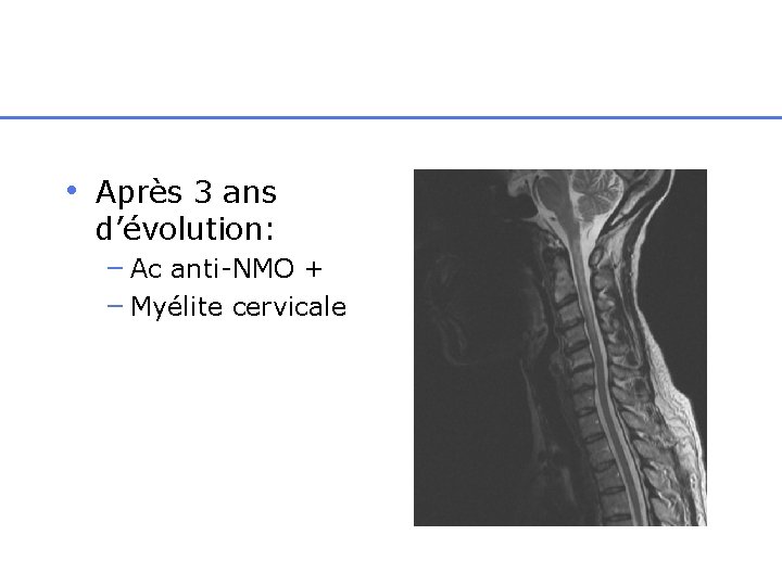  • Après 3 ans d’évolution: – Ac anti-NMO + – Myélite cervicale 