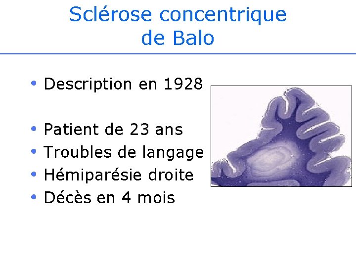 Sclérose concentrique de Balo • Description en 1928 • • Patient de 23 ans