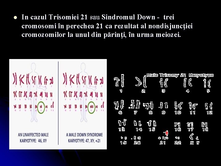 l In cazul Trisomiei 21 sau Sindromul Down - trei cromosomi în perechea 21