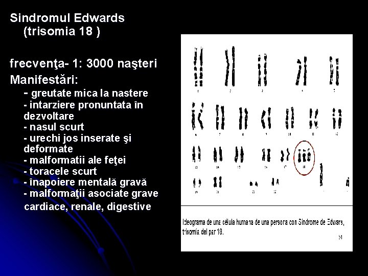 Sindromul Edwards (trisomia 18 ) frecvenţa- 1: 3000 naşteri Manifestări: - greutate mica la