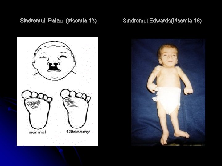 Sindromul Patau (trisomia 13) Sindromul Edwards(trisomia 18) 