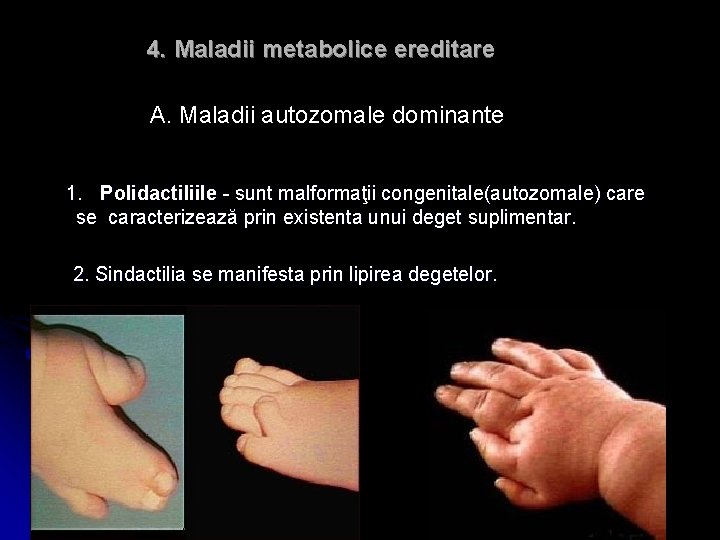 4. Maladii metabolice ereditare A. Maladii autozomale dominante 1. Polidactiliile - sunt malformaţii congenitale(autozomale)