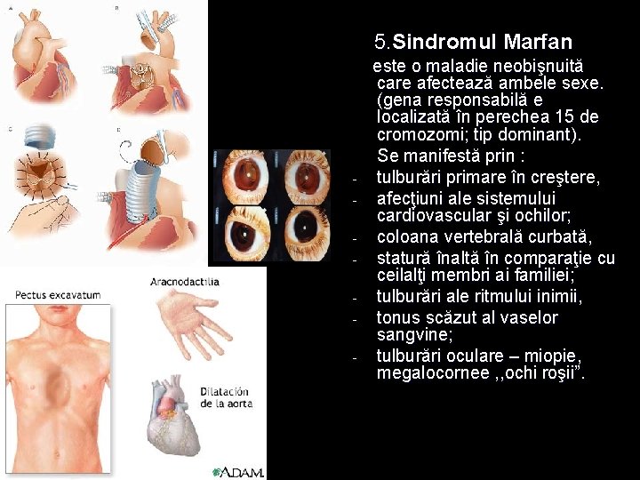 5. Sindromul Marfan - este o maladie neobişnuită care afectează ambele sexe. (gena responsabilă