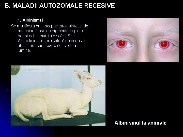 B. MALADII AUTOZOMALE RECESIVE 1. Albinismul Se manifestă prin incapacitatea sintezei de melanina (lipsa