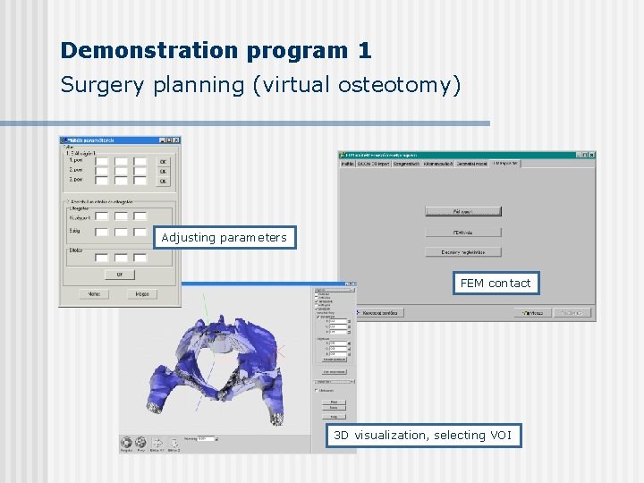 Demonstration program 1 Surgery planning (virtual osteotomy) Adjusting parameters FEM contact 3 D visualization, Demonstration program 1 Surgery planning (virtual osteotomy) Adjusting parameters FEM contact 3 D visualization,