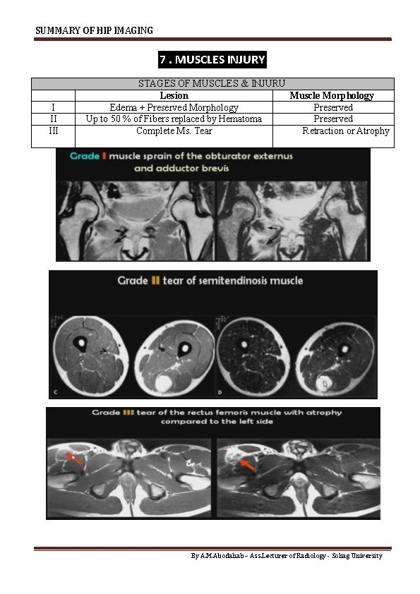 SUMMARY OF HIP IMAGING 7. MUSCLES INJURY I II III STAGES OF MUSCLES &