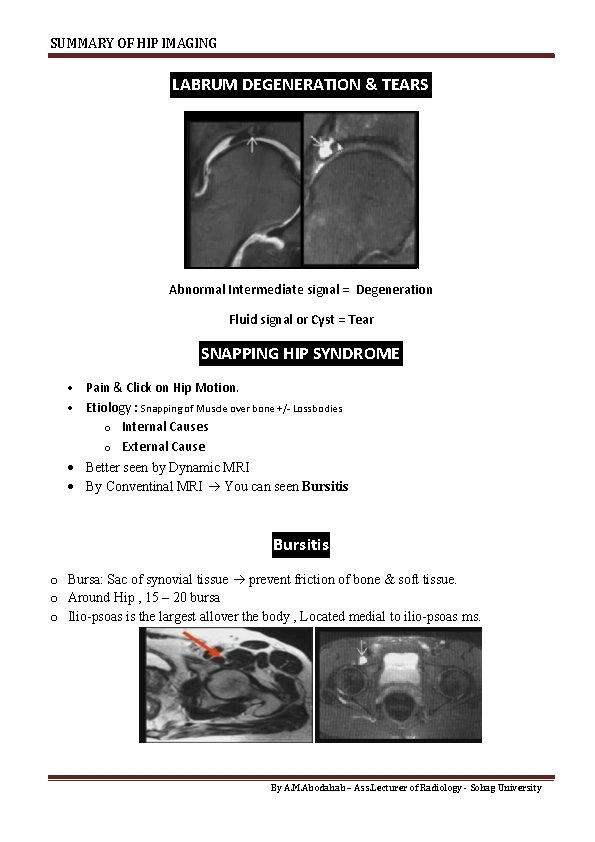 SUMMARY OF HIP IMAGING LABRUM DEGENERATION & TEARS Abnormal Intermediate signal = Degeneration Fluid