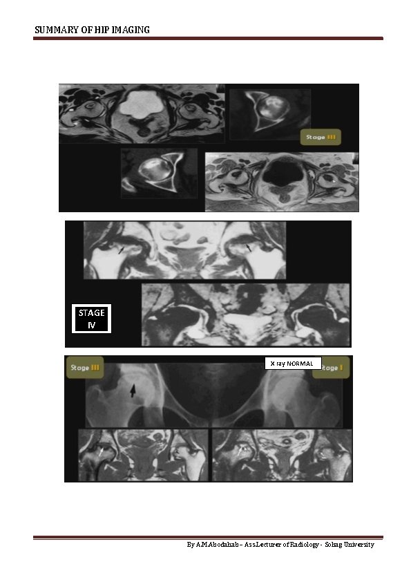 SUMMARY OF HIP IMAGING STAGE IV X ray NORMAL By A. M. Abodahab –