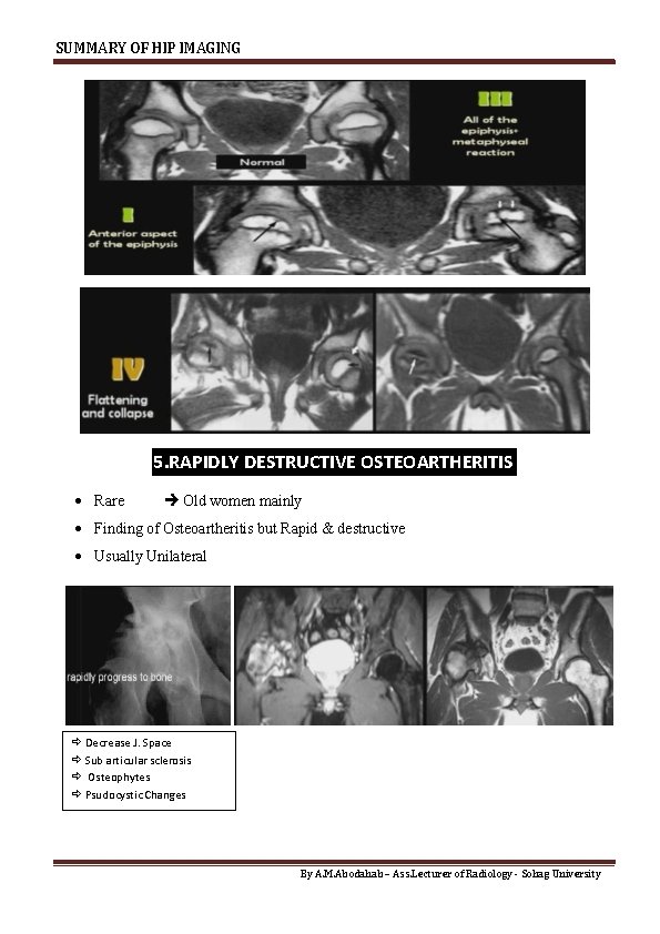 SUMMARY OF HIP IMAGING 5. RAPIDLY DESTRUCTIVE OSTEOARTHERITIS Rare Old women mainly Finding of