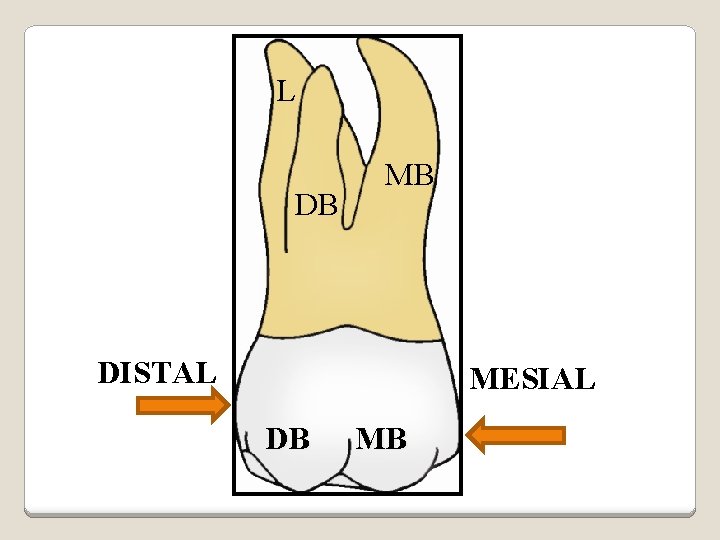 L DB MB DISTAL MESIAL DB MB 