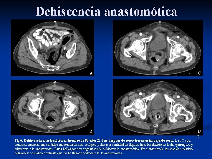 Dehiscencia anastomótica A C B D D Fig 6. Dehiscencia anastomótica en hombre de