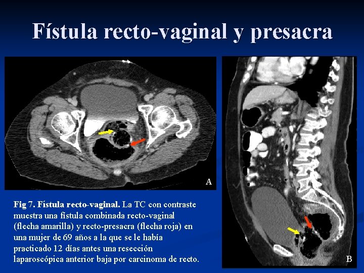 Fístula recto-vaginal y presacra A Fig 7. Fístula recto-vaginal. La TC contraste muestra una