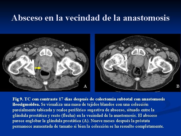 Absceso en la vecindad de la anastomosis A Fig 9. TC contraste 17 días