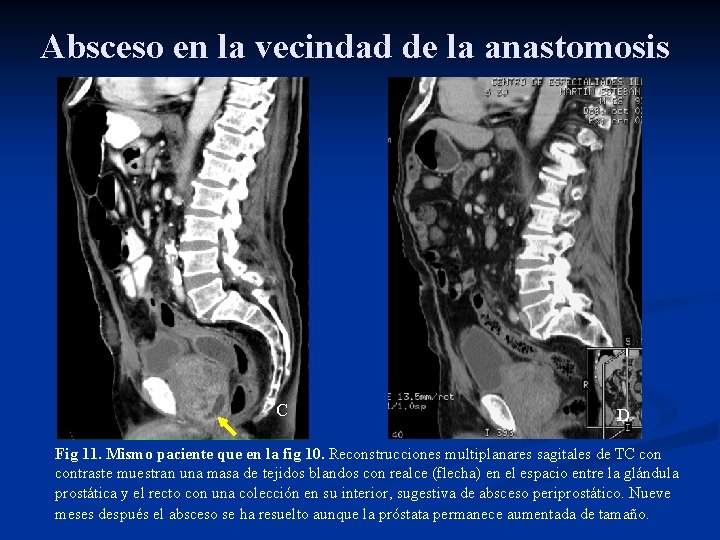 Absceso en la vecindad de la anastomosis C D Fig 11. Mismo paciente que