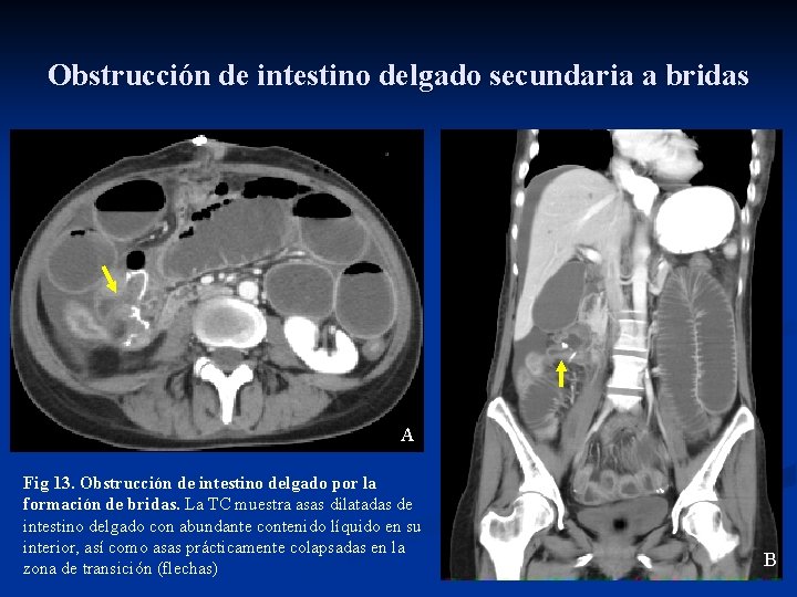 Obstrucción de intestino delgado secundaria a bridas A Fig 13. Obstrucción de intestino delgado