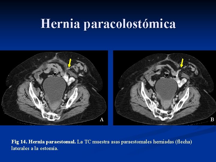Hernia paracolostómica A Fig 14. Hernia paraestomal. La TC muestra asas paraestomales herniadas (flecha)