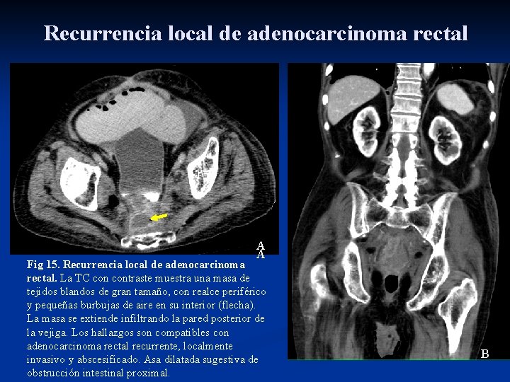 Recurrencia local de adenocarcinoma rectal A A Fig 15. Recurrencia local de adenocarcinoma rectal.