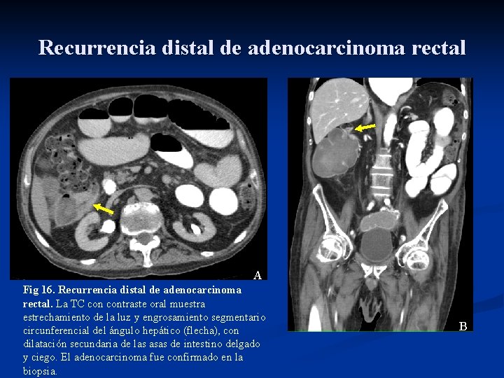 Recurrencia distal de adenocarcinoma rectal A Fig 16. Recurrencia distal de adenocarcinoma rectal. La