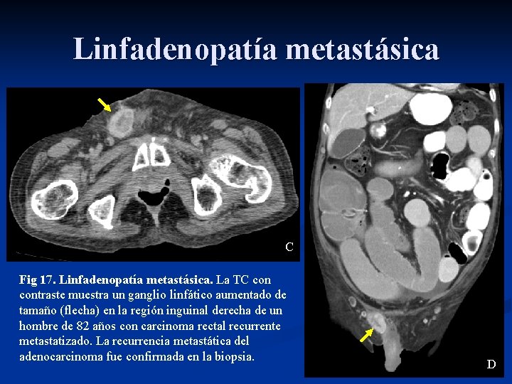 Linfadenopatía metastásica C Fig 17. Linfadenopatía metastásica. La TC contraste muestra un ganglio linfático