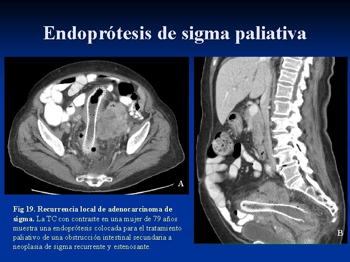 Endoprótesis de sigma paliativa A Fig 19. Recurrencia local de adenocarcinoma de sigma. La