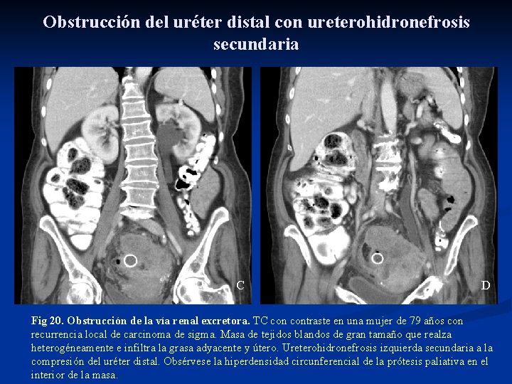 Obstrucción del uréter distal con ureterohidronefrosis secundaria C D Fig 20. Obstrucción de la