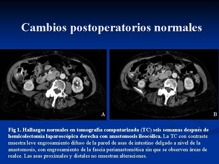 Cambios postoperatorios normales A Fig 1. Hallazgos normales en tomografía computarizada (TC) seis semanas