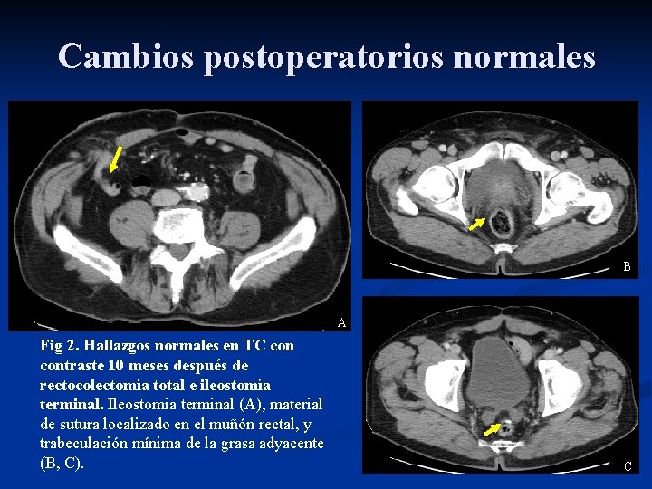 Cambios postoperatorios normales B A Fig 2. Hallazgos normales en TC contraste 10 meses