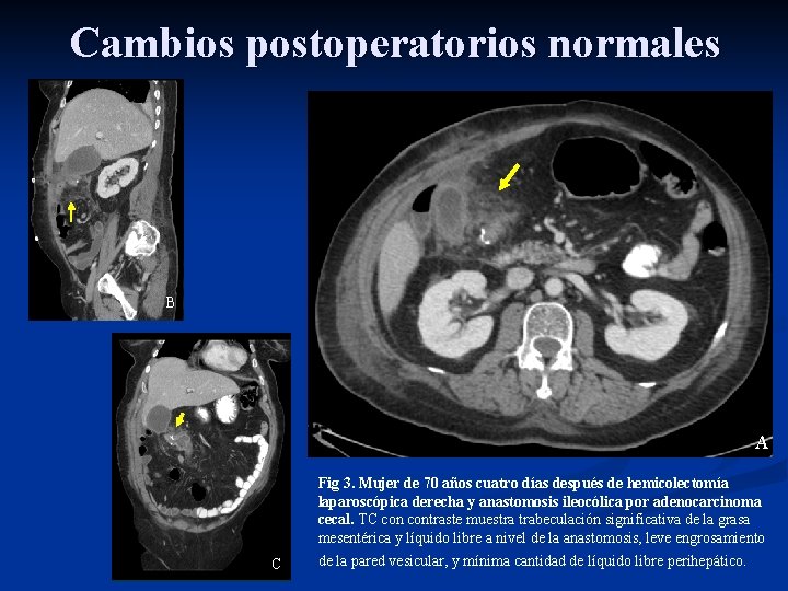 Cambios postoperatorios normales B A C Fig 3. Mujer de 70 años cuatro días