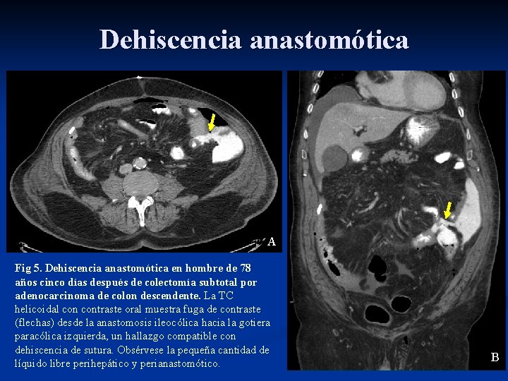 Dehiscencia anastomótica A Fig 5. Dehiscencia anastomótica en hombre de 78 años cinco días