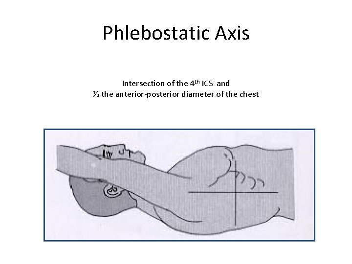 Phlebostatic Axis Intersection of the 4 th ICS and ½ the anterior-posterior diameter of Phlebostatic Axis Intersection of the 4 th ICS and ½ the anterior-posterior diameter of