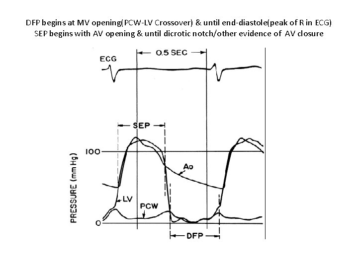 DFP begins at MV opening(PCW-LV Crossover) & until end-diastole(peak of R in ECG) SEP DFP begins at MV opening(PCW-LV Crossover) & until end-diastole(peak of R in ECG) SEP