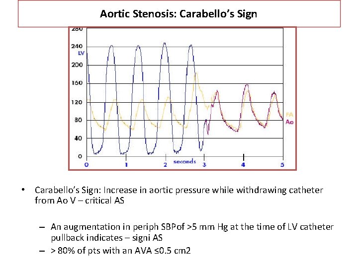 Aortic Stenosis: Carabello’s Sign • Carabello’s Sign: Increase in aortic pressure while withdrawing catheter Aortic Stenosis: Carabello’s Sign • Carabello’s Sign: Increase in aortic pressure while withdrawing catheter