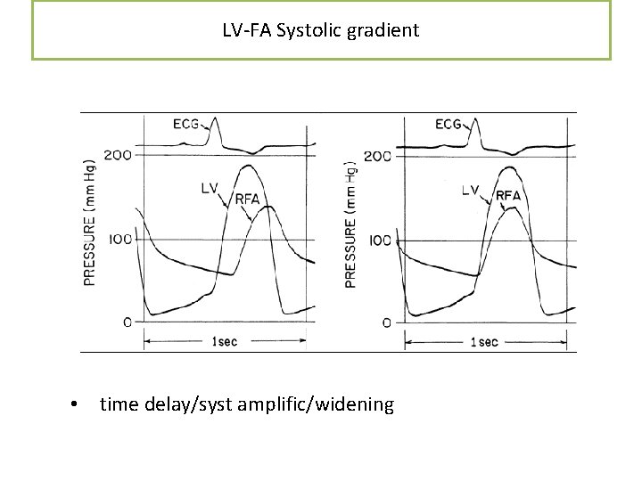 LV-FA Systolic gradient • time delay/syst amplific/widening LV-FA Systolic gradient • time delay/syst amplific/widening