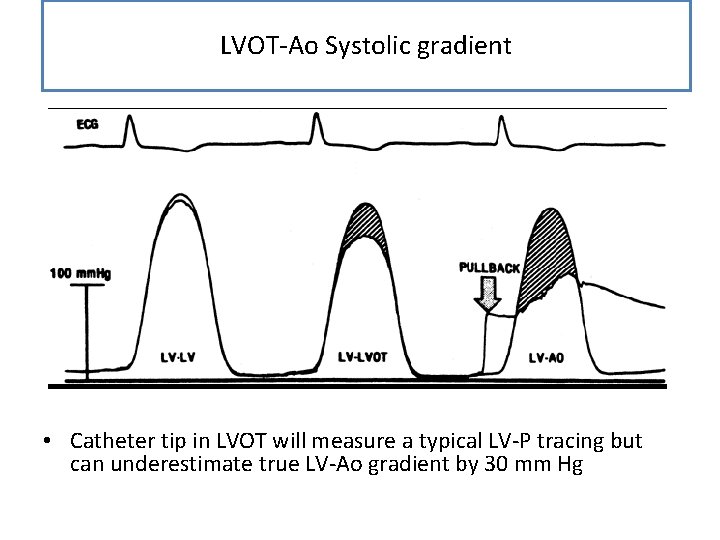 LVOT-Ao Systolic gradient • Catheter tip in LVOT will measure a typical LV-P tracing LVOT-Ao Systolic gradient • Catheter tip in LVOT will measure a typical LV-P tracing