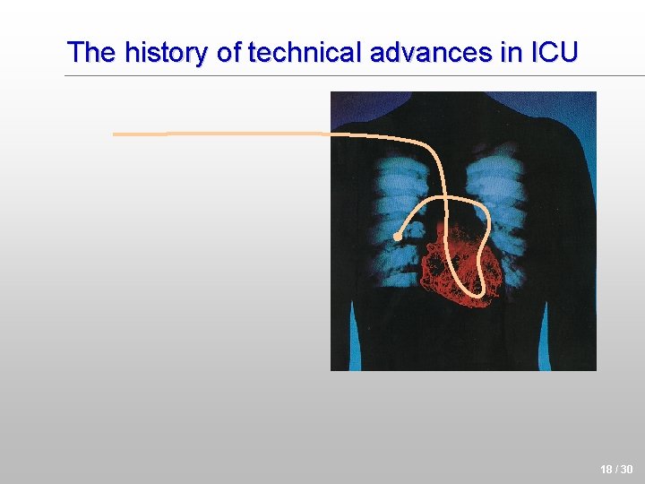 The history of technical advances in ICU 18 / 30 